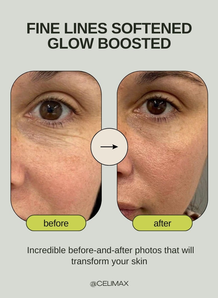 معزز شد شبكية العين سيليماكس